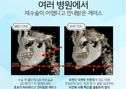 韩国丽珍轮廓修复3D-CT对比图