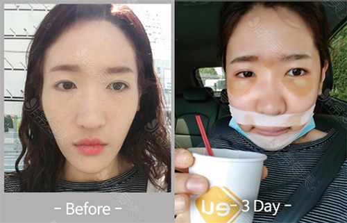 韩国EU颌面轮廓整形外科长脸双鄂整形术前照片