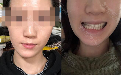 韩国EU颌面轮廓整形外科面部不对称矫正术前照片