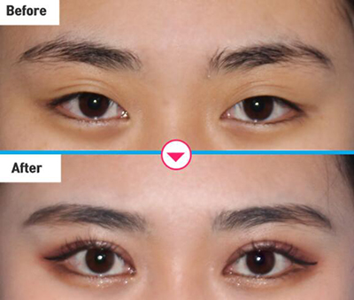 韩国清潭瑞整形外科眼部整形前后对比照片