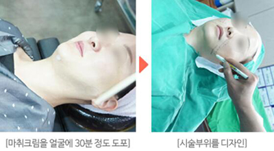 韩国KIES-U整形外科面部提升手术过程图