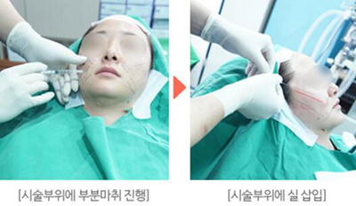 韩国KIES-U整形外科面部提升手术过程照片