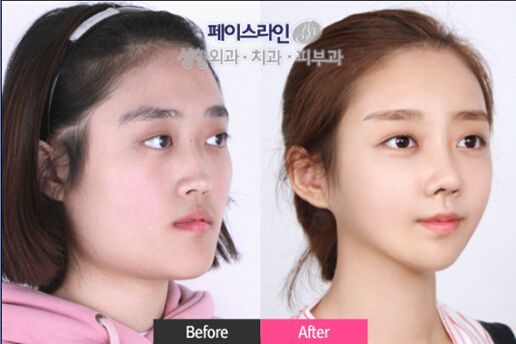 下颌角手术后脸还是很大 韩国菲斯莱茵揭秘原因