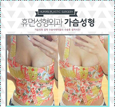 韩国秀梦整形外科隆胸术后照片