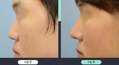 韩国秀梦HUMAN整形外科鼻部矫正案例图