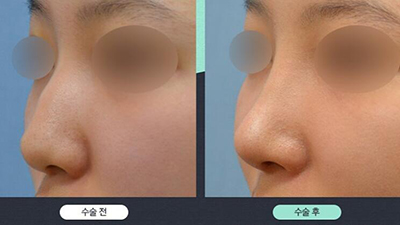 韩国秀梦HUMAN整形外科驼峰鼻矫正前后对比照片