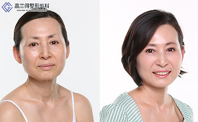 韩国高兰得整形外科面部提升前后对比照片