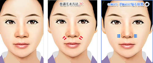 韩国高诺鼻鼻整形手术优势