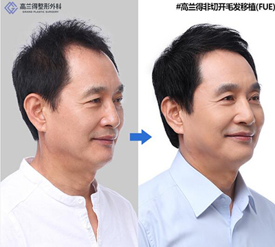 韩国高兰得整形外科毛发移植前后对比照片