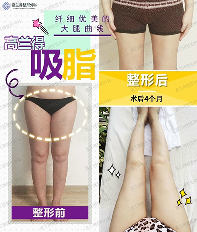 韩国高兰得整形外科腿部吸脂案例图