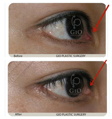 韩国GIO修复眼角疤痕图片
