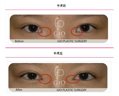 韩国GIO修复眼角疤痕真人