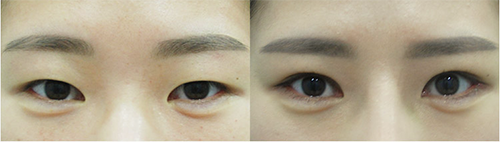韩国faceplus眼部手术对比