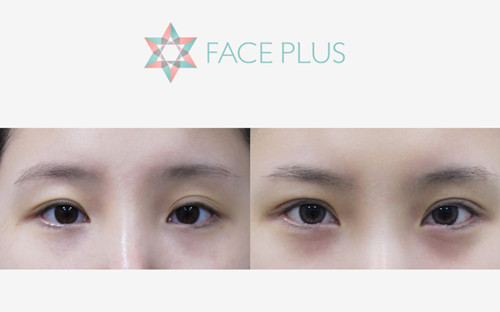 韩国Faceplus双眼皮手术真人