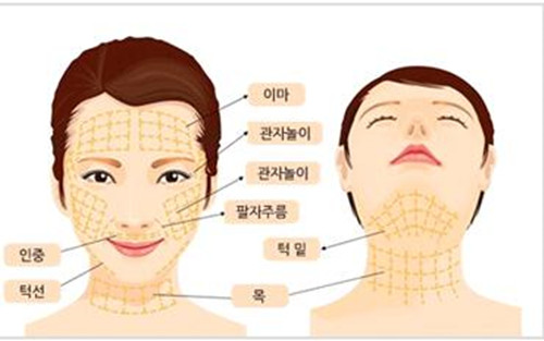 韩国bio金线提升手术部位图示
