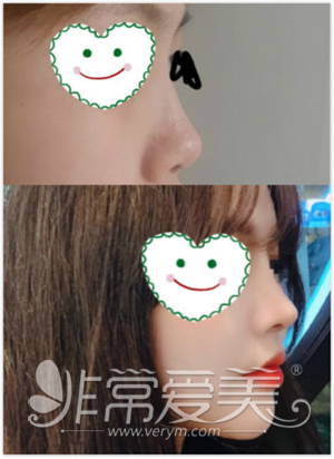 韩国丽丝塔隆鼻对比照片