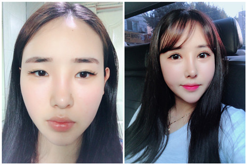 韩国pop整形外科眼修复真人
