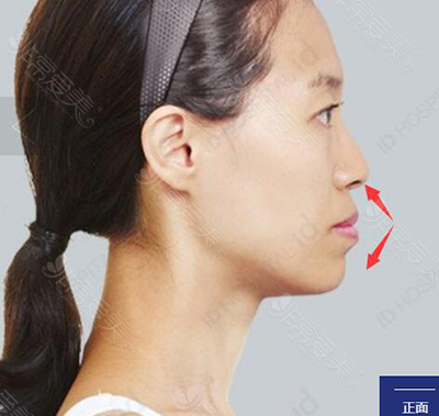 凸嘴和双鄂手术区别有哪些，韩国医院如何矫正？