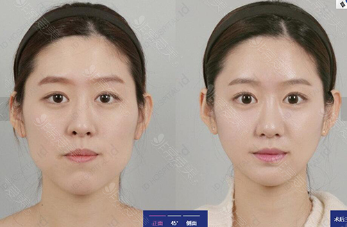 韩国ID整形外科凸嘴矫正图