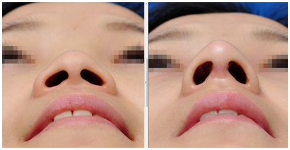 韩国医院鼻翼缩小手术多少钱？多组日记说明手术细节特点