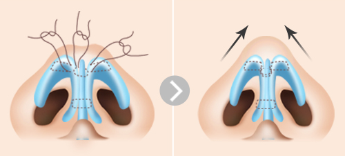 韩国医院鼻翼缩小手术是如何让做的？