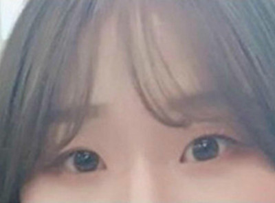 韩国本爱整形做眼睛怎么样？日记图合辑看你是否喜欢！
