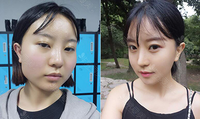 韩国GNG做轮廓眼鼻手术怎么样，医院真人案例效果如何？