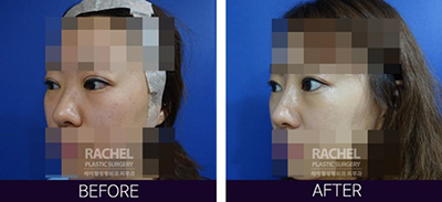 双眼皮修复手术对比案例