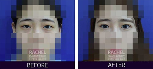 韩国蕾切尔整形外科双眼皮手术对比案例