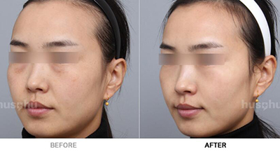 韩国HUSHU皮肤科面部提升前后照片