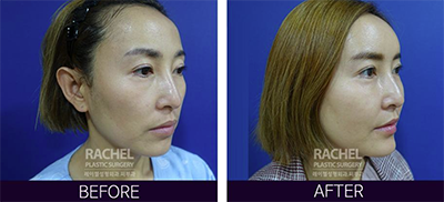 韩国蕾切尔整形外科面部脂肪填充手术对比案例