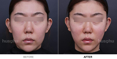 韩国HUS-HU皮肤科面部提升前后对比照片
