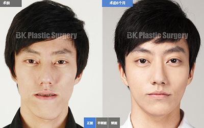 韩国BK整形外科双鄂手术前后对比照片