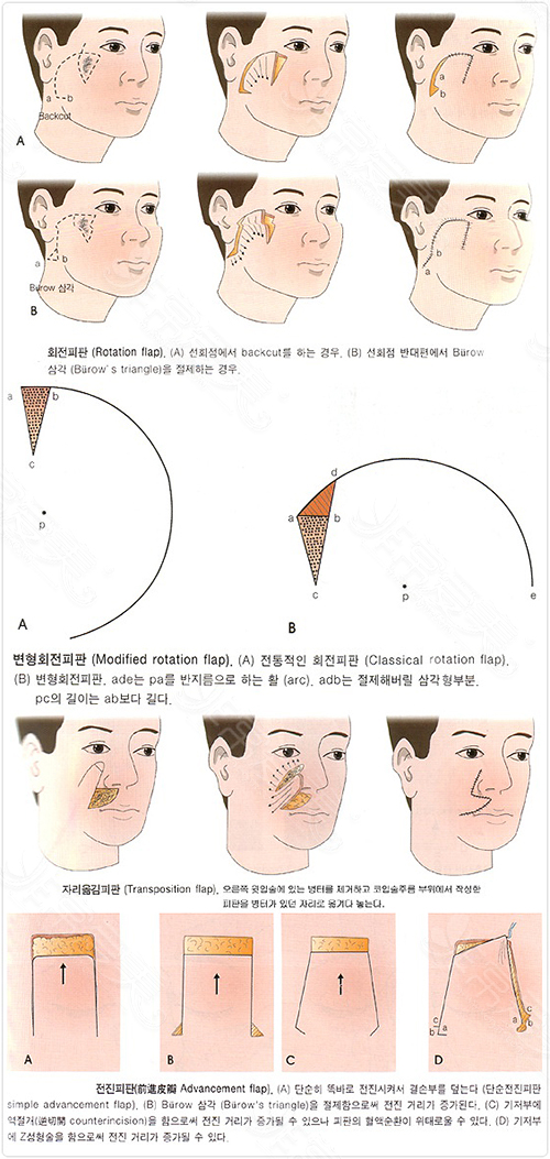韩国Dr.ham's整形医院疤痕切除方法示意图