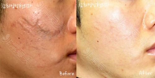 韩国Dr.ham's整形医院面部疤痕治疗照片