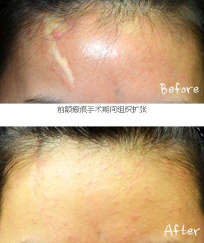 韩国Dr.ham's整形医院额头疤痕治疗照片