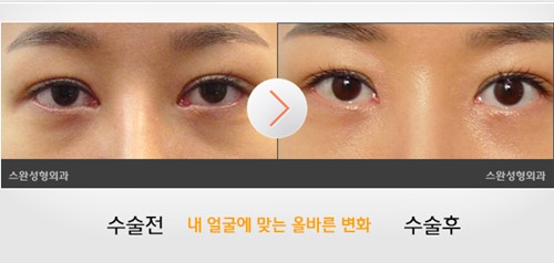 韩国Swan整形眼角修复