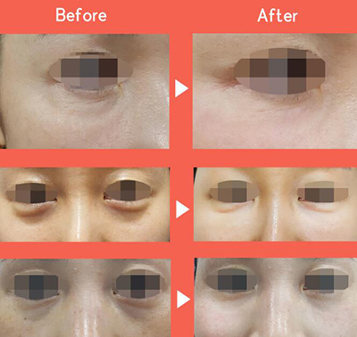 韩国815抗衰老中心眼袋治疗前后照片