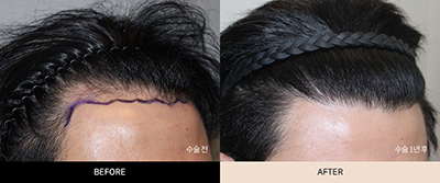 韩国毛宝璐发际线移植对比
