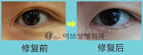 韩国眼角修复医院名单：Swan整形eve和GIO各有特色！