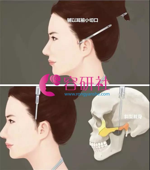 颧骨颧弓手术切口