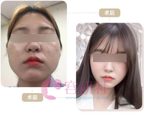韩国profile整形医院面部轮廓手术案例