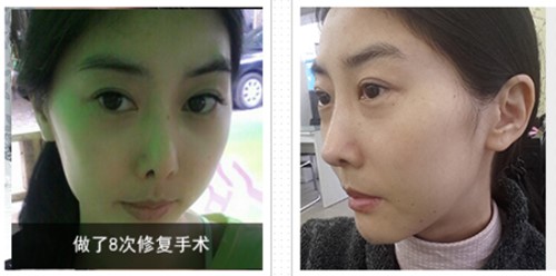 韩国明星去的鼻整形医院有哪些?朱诺、nano、4月31在列吗?