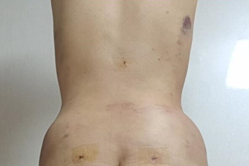 韩国babiline腰腹吸脂术后两天图
