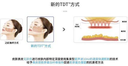 一针就能消灭眉间纹、下巴核桃纹、八字纹，还有大圆脸