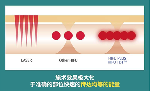 韩国美尔韩方医院无痛超声提升效果好吗？