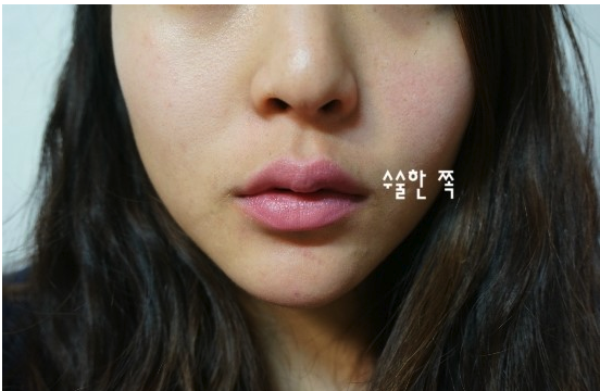 韩国drham治疗疤痕贵吗？真实效果告诉你这样收费没毛病！