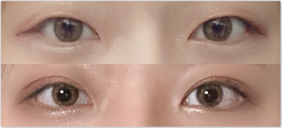 韩式双眼皮日记对比