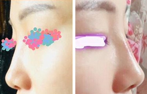 韩国LeeYoung整形玻尿酸隆鼻案例图