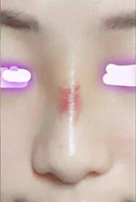 韩国LeeYoung整形玻尿酸隆鼻案例图